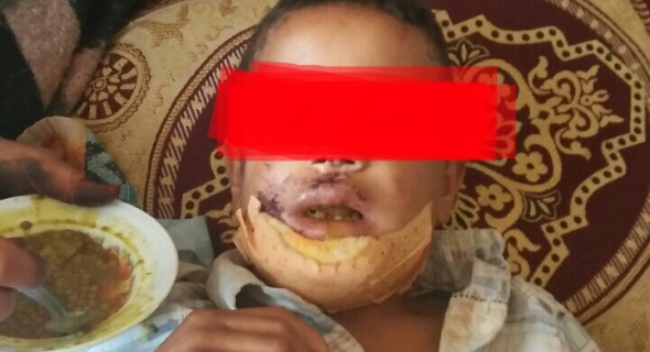 الفقراء ليهم الله… تلميذ مصاب في  حادثة سير يعاني الاهمال بالمستشفى الجهوي و رجله في تعفن مستمر ومطالبة بعلاجه 