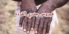 الصحة العالمية تعلن حالة الطوارئ الصحية لمواجهة تفشي جدري القردة